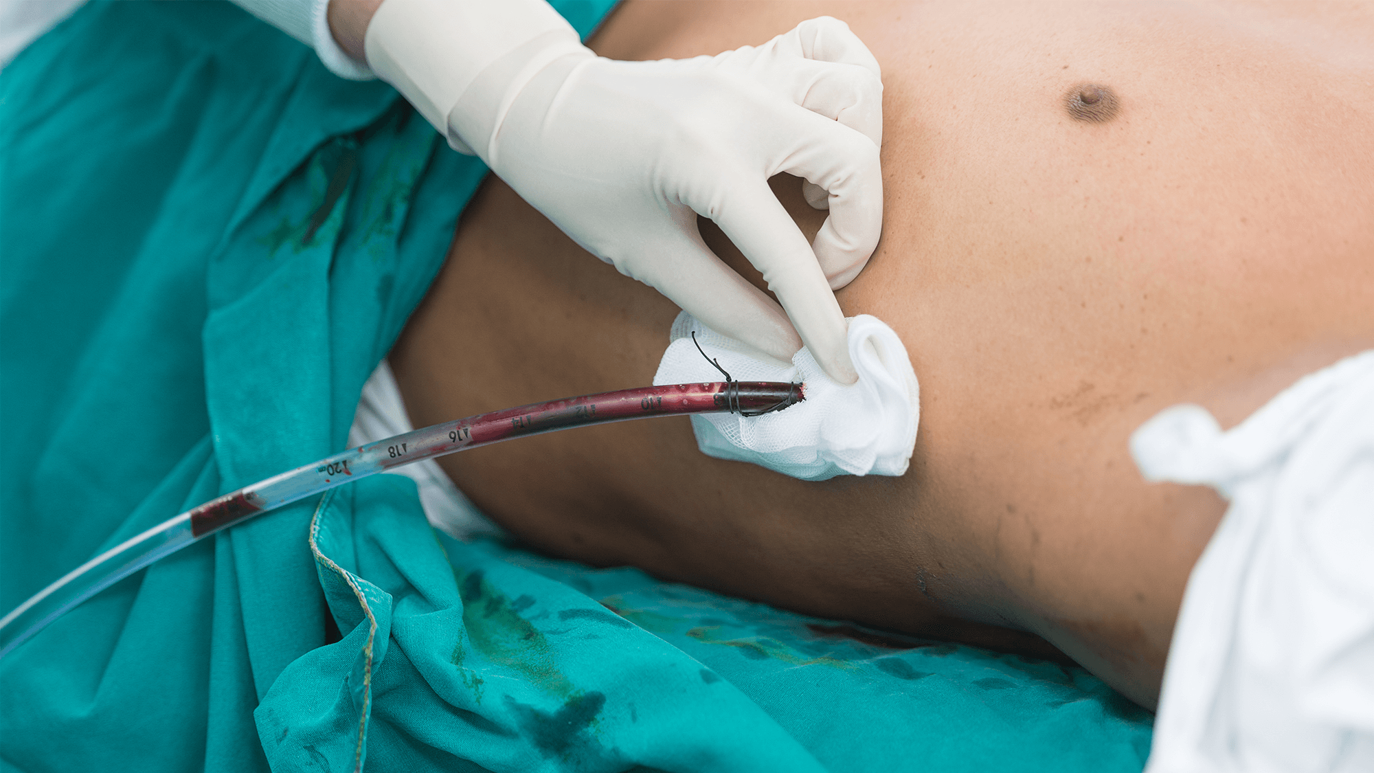 casestudy2024chesttube 16x9